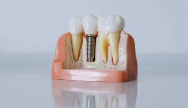 Model of dental implant