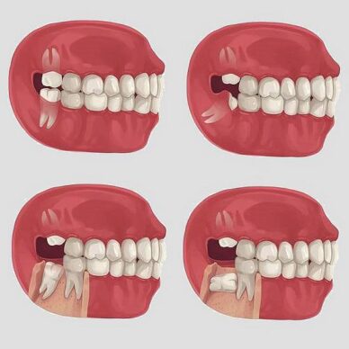 Varying positions of wisdom teeth