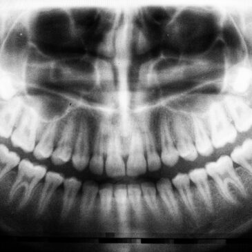 xray of teeth